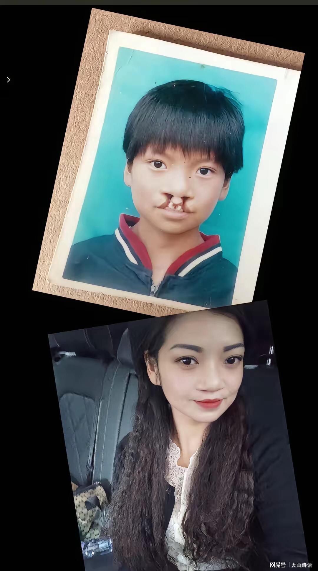 澳洲幸运10-震惊!为声援李亚鹏,一漂亮女孩坦然展示自己唇腭裂手术前后照片